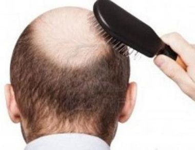 脱发有什么危害 ​脱发严重用什么洗发水