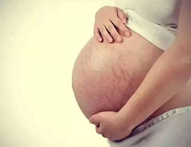 妊娠纹痒怎么办 怎么解决妊娠纹痒的问题