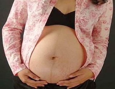 妊娠纹如何预防 怎么做才不会出现妊娠纹