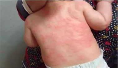 婴儿湿疹的症状 婴儿湿疹洗脸前注意什么