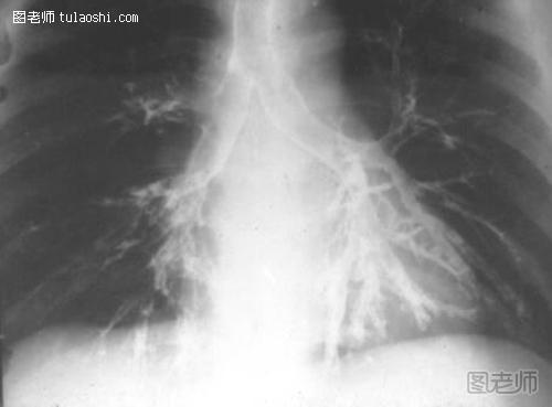 支气管性双肺纹理增多