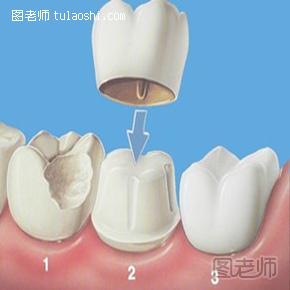 牙齿整形有什么危害  牙齿整形应该注意什么