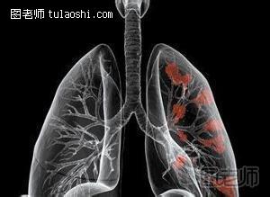 如何发现早期肺癌 肺癌的早期症状
