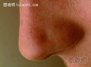 鼻窦骨瘤的治疗方法