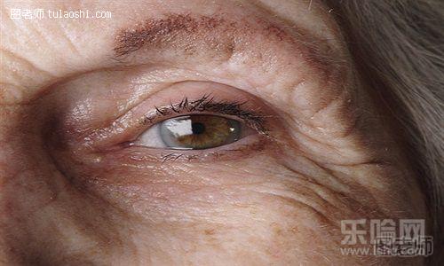 青光眼的早期症状是什么样子