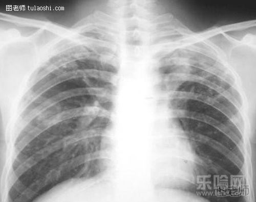 什么样的肺癌拍片可以检查出来