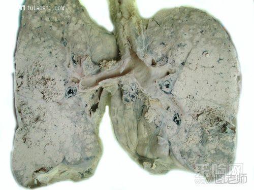 肺癌传染吗