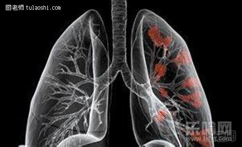 什么是肺癌