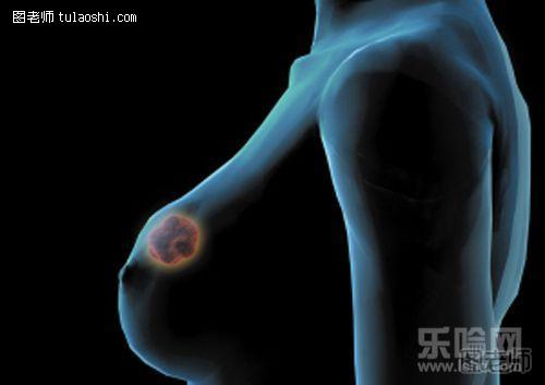 【图】乳腺癌晚期症状_图老师
