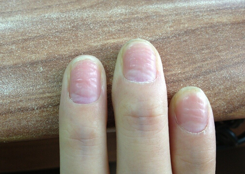 手指甲凹凸不平的危害-如何预防手指甲凹凸不平