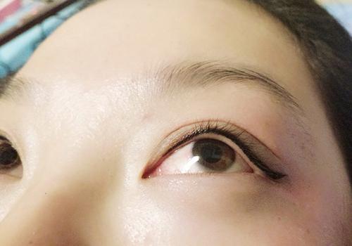 纹美瞳线造成眼球刺激