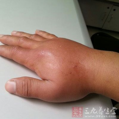 手部若被重物压伤，皮肤大多不会破，而出现皮下青紫或血肿