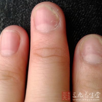 勿剪茧皮：灰指甲护理勿剪指甲两侧的茧皮