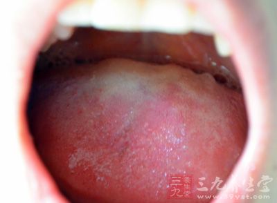 口腔黏膜白斑是一种怎么样的疾病呢