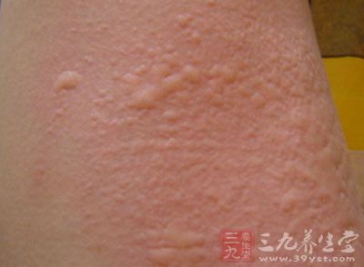 荨麻疹是皮肤病中常发生的一种，俗称风团、风疙瘩、风疹块