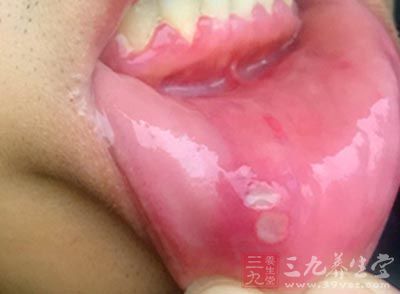 认为口腔溃疡是一种正常现象或者是一种缺乏维生素的现象