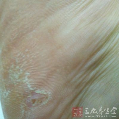 皮肤癣菌病根据不同的发病部位可以分为足癣俗称脚气