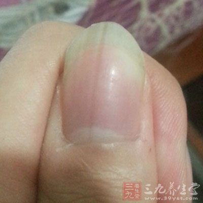 指甲有竖纹的成因及治疗方法
