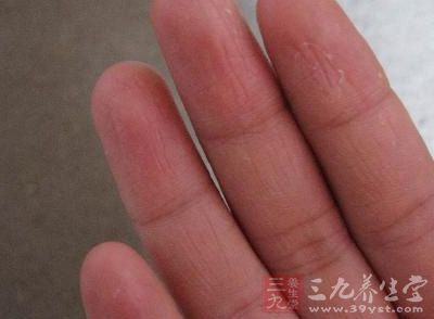 手癣，其实俗称鹅掌风，它是一种发病率不低的皮肤病