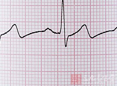 心电图上也可以看出心脏早搏的症状