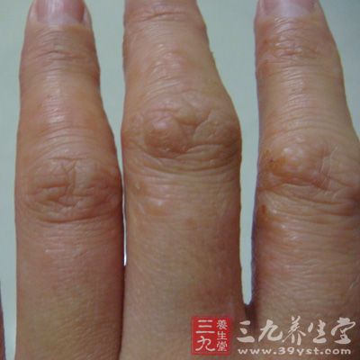 手指端湿疹常反复发生水疱、结痂