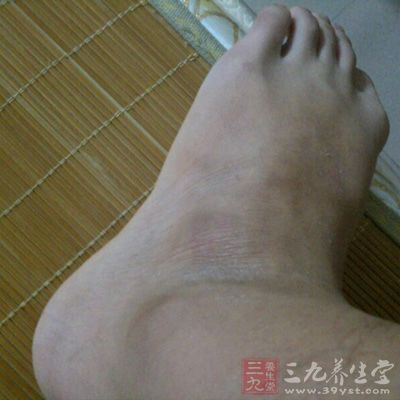 腓骨肌腱鞘炎引起的外踝以下的慢性肿胀，是由于行走时踝内翻造成疼痛性扭伤