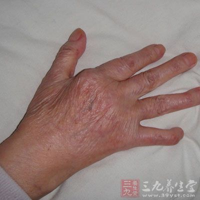 手的畸形有梭形肿胀、尺侧偏斜、天鹅颈样畸形