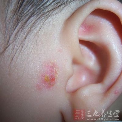 皮肤表现为多数群集的小红丘疹及红斑