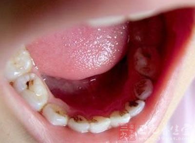 龋齿俗称虫牙、蛀牙，是细菌性疾病