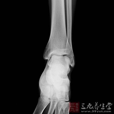X光片可见骶髂关节侵袭、破坏或融合