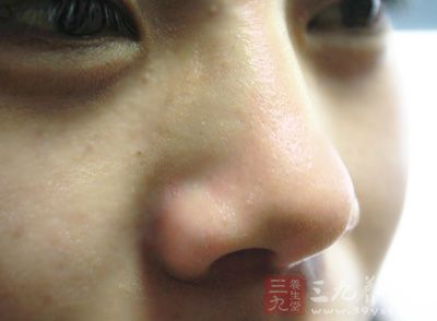 鼻中隔向一侧或两侧弯曲，或鼻中隔一侧或两侧局部突起