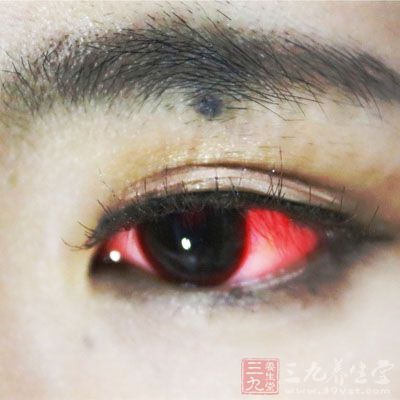 眼睛中总是出现红血丝是眼部炎症的初期表现
