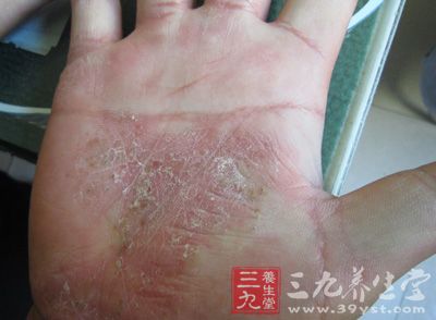牛皮癣，又叫银屑病，是一种常见的具有特征性皮损的慢性易于复发的炎症性皮肤病