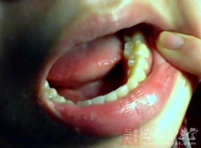 蛀牙痛其主要形成原因是牙齿菌斑