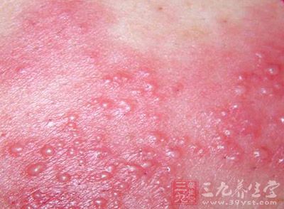 成人患水痘，其症状较儿童严重，表现为高热持续不退，全身症状严重，皮疹融合成片，并发症易见如肝炎、肺炎等，应加以注意