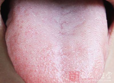 吃槟榔引起的口腔黏膜白斑症常见于颊黏膜、舌、口底及唇角