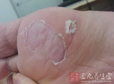 脚气是会传染的，而脚气一般都是由于真菌而且引发的脚气病