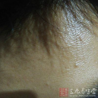 白头粉刺的症状为小粉刺，皮脂或老化角质堵塞毛孔