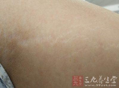 生长纹也是一种皮肤病，人的皮肤中有弹力纤维，在生长过程中导致皮肤弹性纤维发生断裂