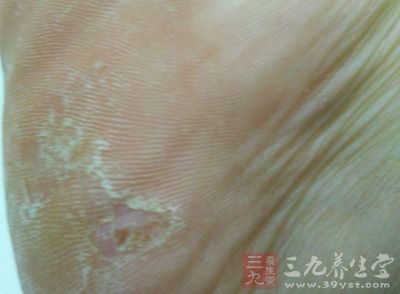 脚气是一种极常见真菌性皮肤病，一般常见于男性朋友