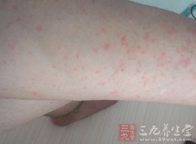 湿疹是一种非常常见的皮肤类的疾病
