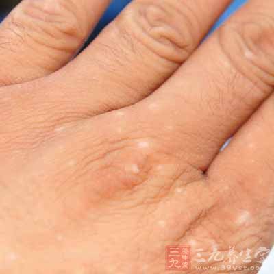 白癜风症状较常见于指背