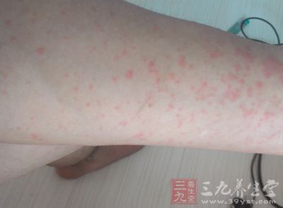 夏季皮肤病有很多，一般会有湿疹、皮炎、荨麻疹等等