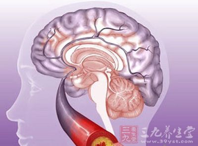 脑血栓形成是脑梗死最常见的类型