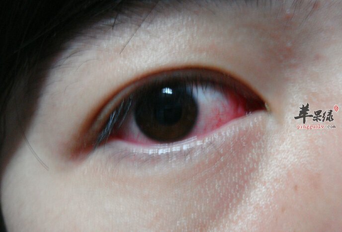 红眼的小偏方
