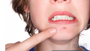 嘴巴周围长痘痘的原因是什么