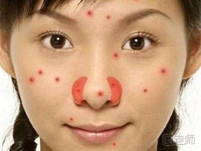 鼻子上长痘痘是什么原因
