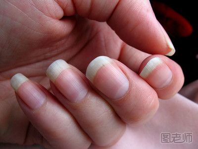 指甲上有竖纹是为什么 为什么指甲上会有竖纹