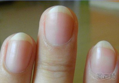 指甲上有竖纹是为什么 为什么指甲上会有竖纹