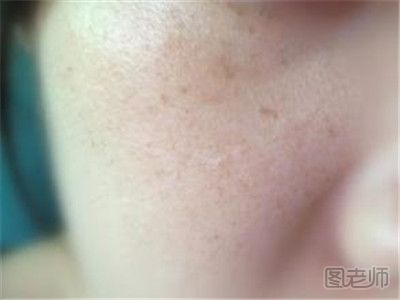 脸上常见的斑点有哪些 斑点的种类